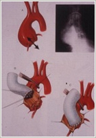 A Bentall-DeBono féle aortagyök rekonstrukciós eljárás sémás rajza.