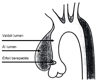 Sémás rajz az akut "A" típusú aorta disszekció során kialakuló érfali berepedésről, s az állumen illetve a valódi lumen elkülönüléséről.