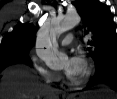 Az aorta disszekció CT ábrázolása, melyen jól láthatóak az aorta ascendensben lévő hosszanti érfali szétszakadások.