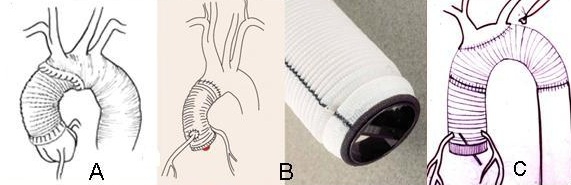 Az "A" típusú aorta disszekció esetén szükségessé váló aorta rekonstrukciós eljárások sémás bemutatása: aortagyök megtartás, Bentall-DeBono eljárás, aortaív csere.