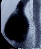 Bentall műtét - Preoperatív CT angiographia