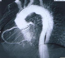 Bentall műtét - Posztoperatív CT angiographia