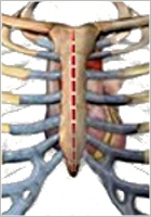Mini-sternotomia sémás rajza.