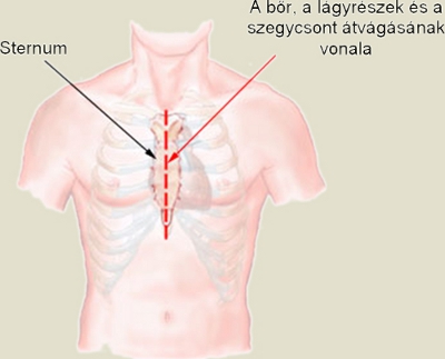 A sternotomia során ejtett bőrmetszés pozíciójának bemutatása torzón.