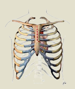 Mini-sternotomiának, vagyis szegycsont részleges átvágásának sémás ábrázolása.